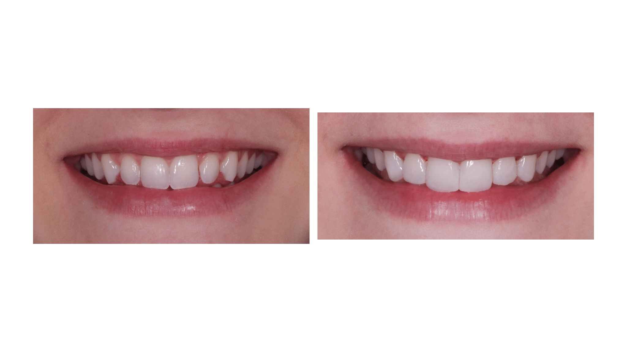 Dra. Fernanda Baboni - Lentes de Contato Dental Facetas em Curitiba 01