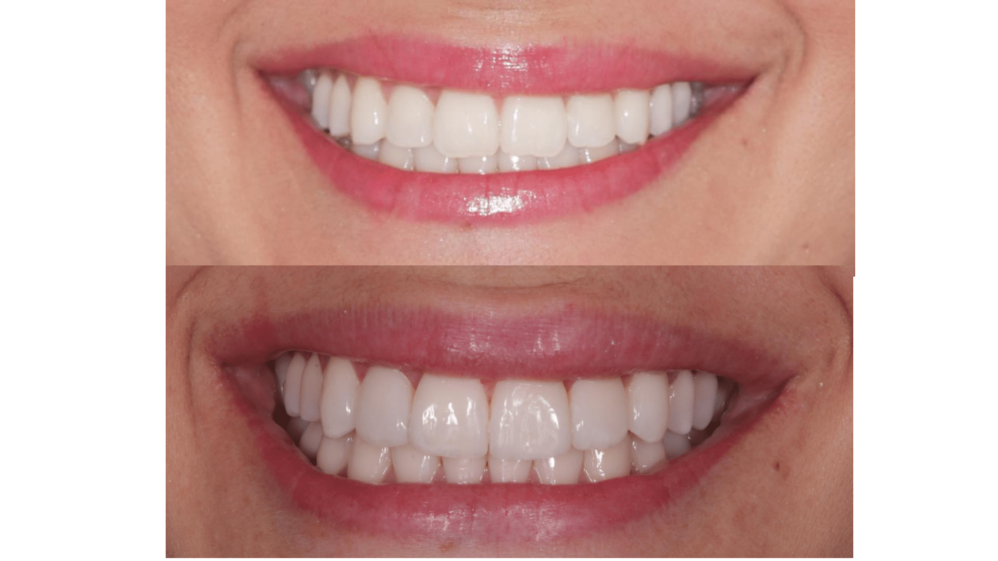 Dra. Fernanda Baboni - Lentes de Contato Dental Facetas em Curitiba 02
