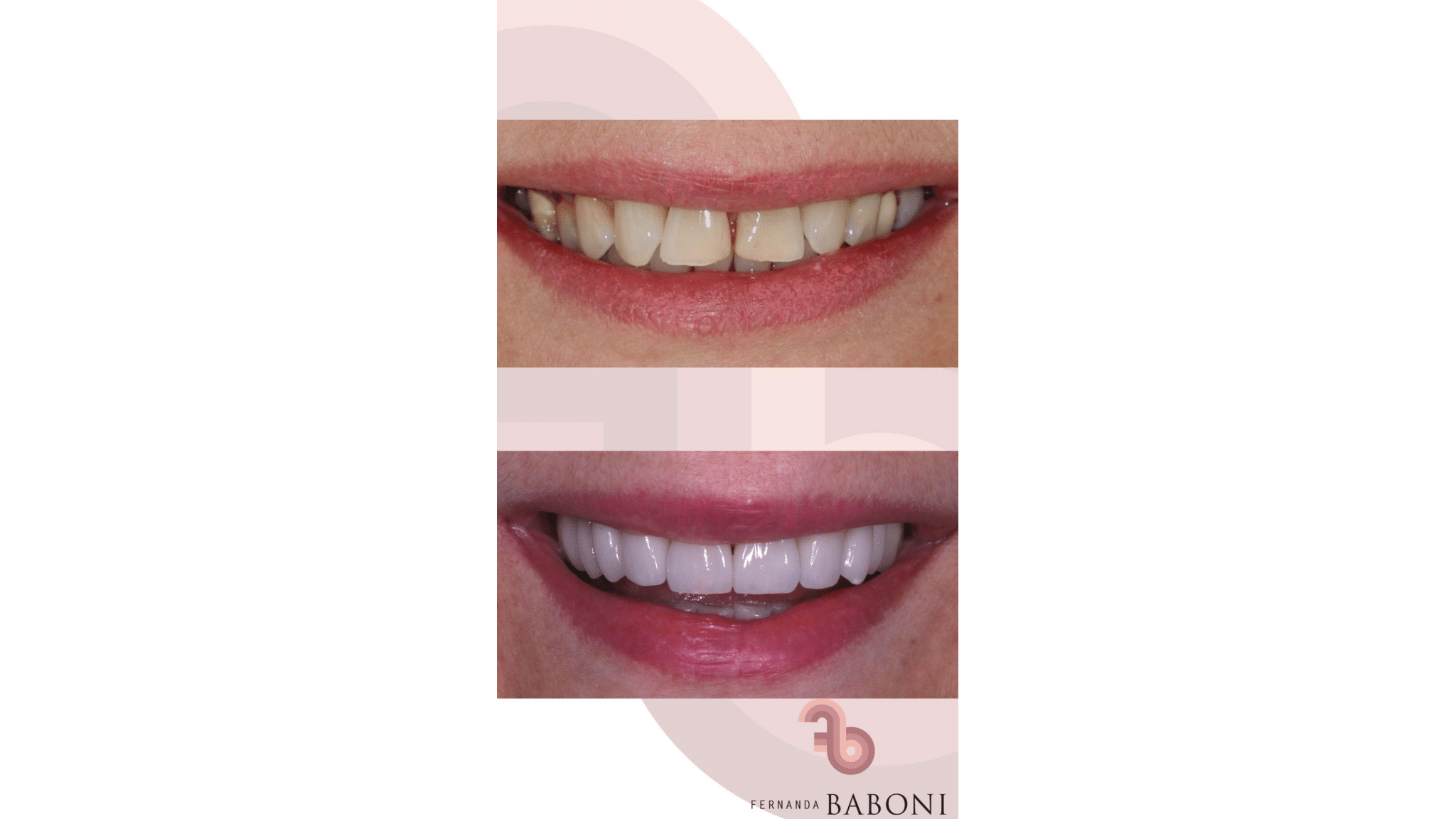 Dra. Fernanda Baboni - Lentes de Contato Dental Facetas em Curitiba 03