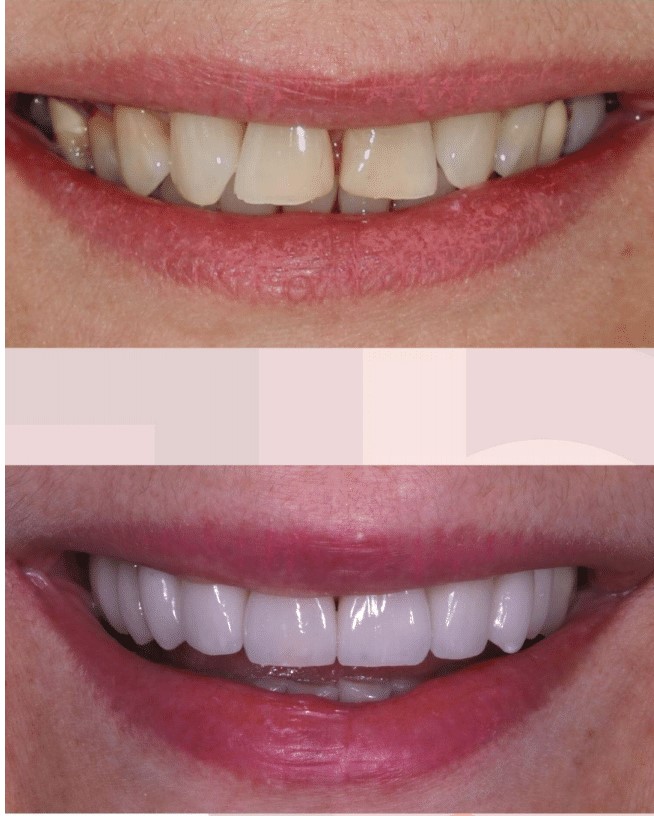 Dra. Fernanda Baboni - Lentes de Contato Dental Facetas em Curitiba 04