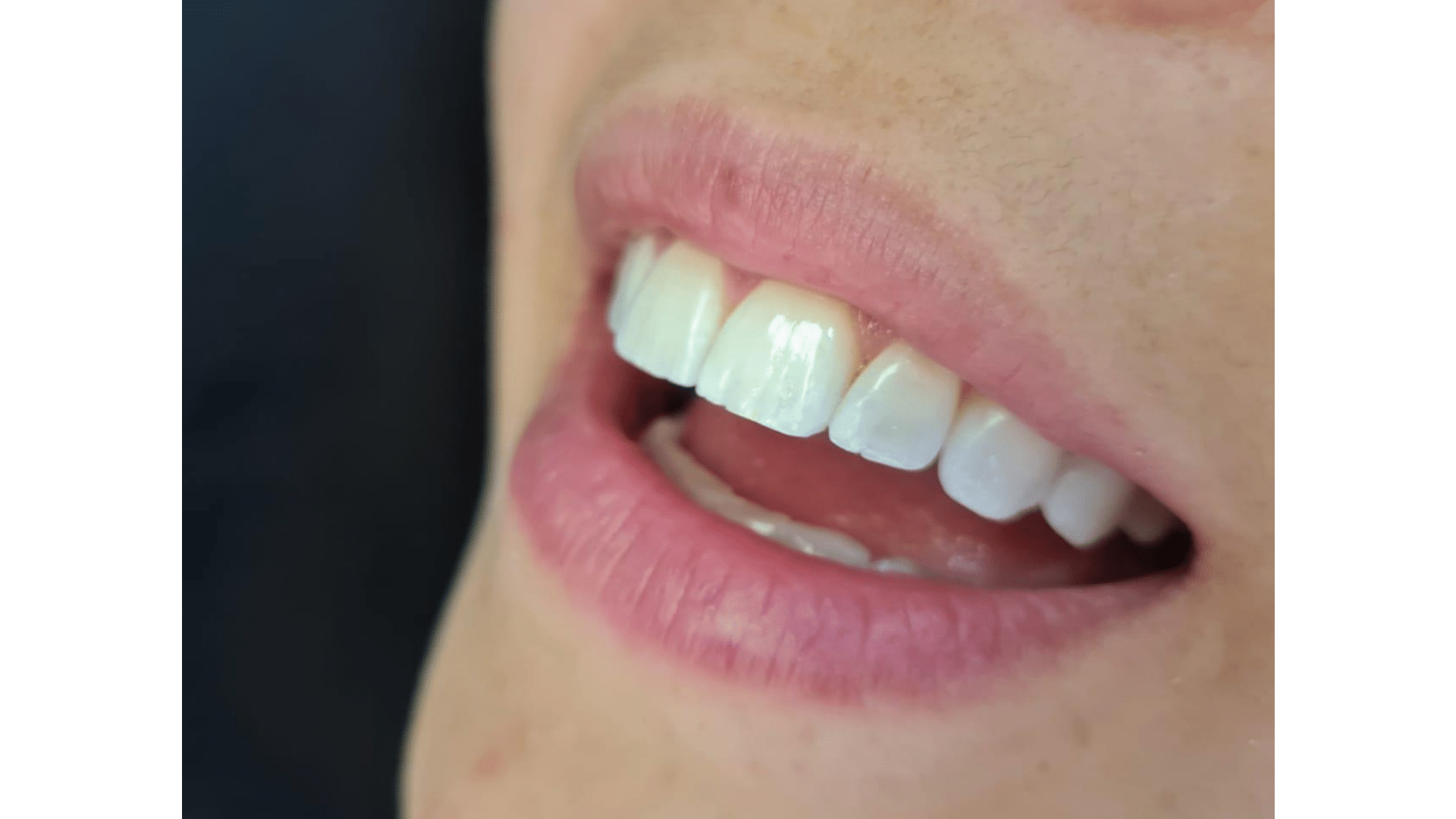 Dra. Fernanda Baboni - Lentes de Contato Dental Facetas em Curitiba 05
