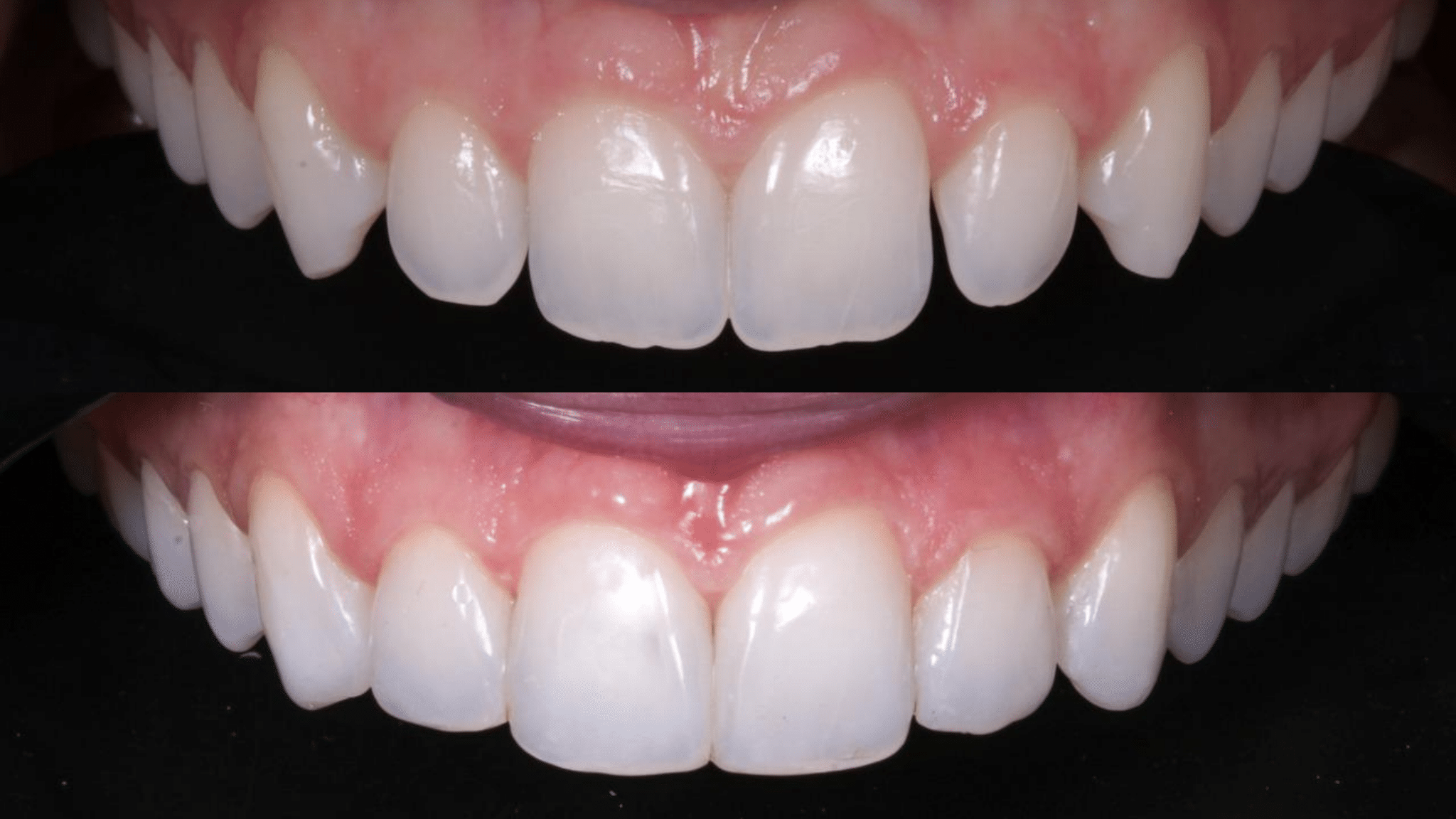 Dra. Fernanda Baboni - Lentes de Contato Dental Facetas em Curitiba 06