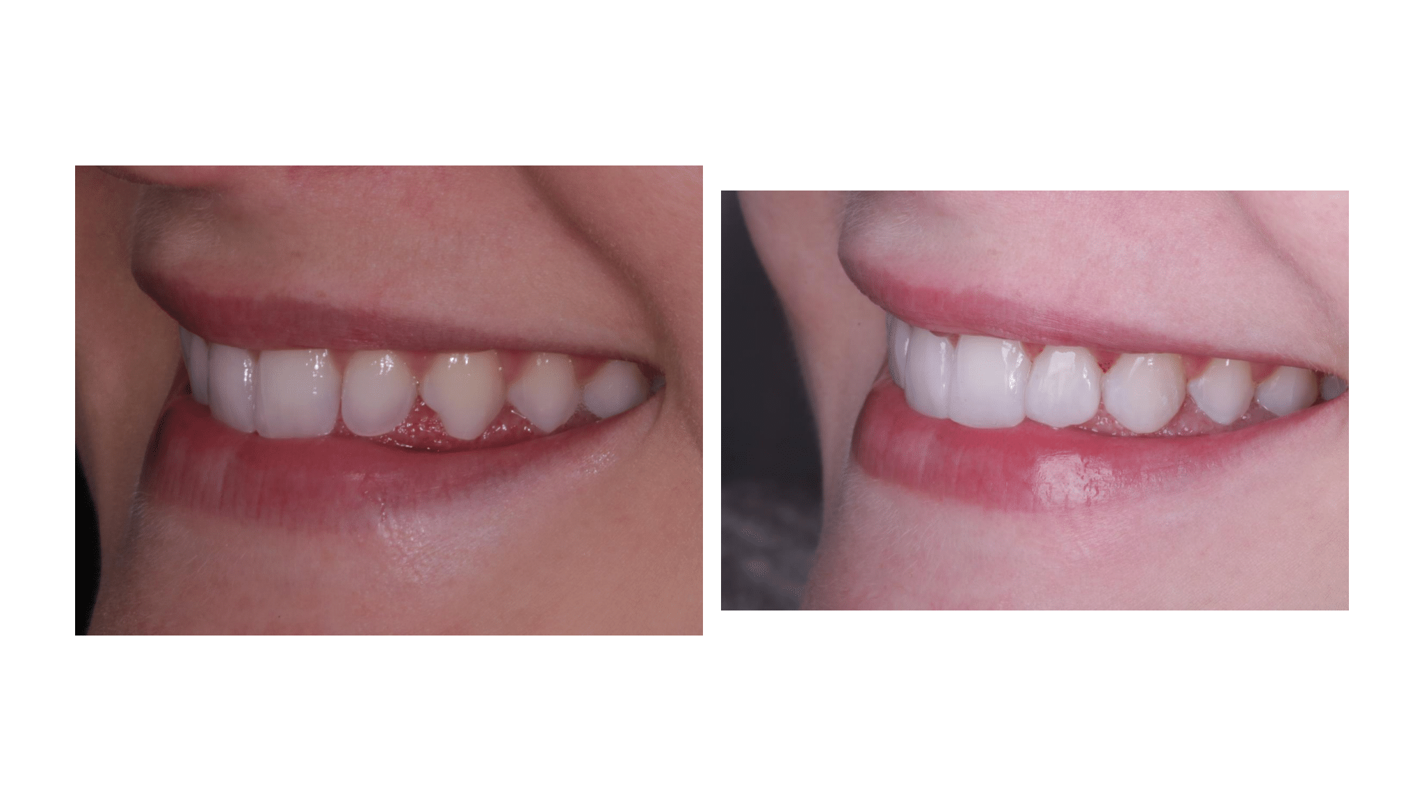 Dra. Fernanda Baboni - Lentes de Contato Dental Facetas em Curitiba 07