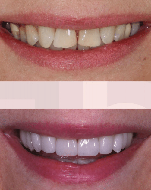 Dra. Fernanda Baboni - Lentes de Contato Dental Facetas em Curitiba 08