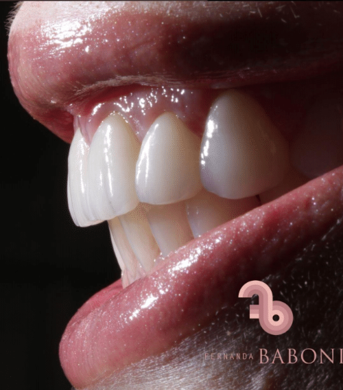 Dra. Fernanda Baboni - Lentes de Contato Dental Facetas em Curitiba 10