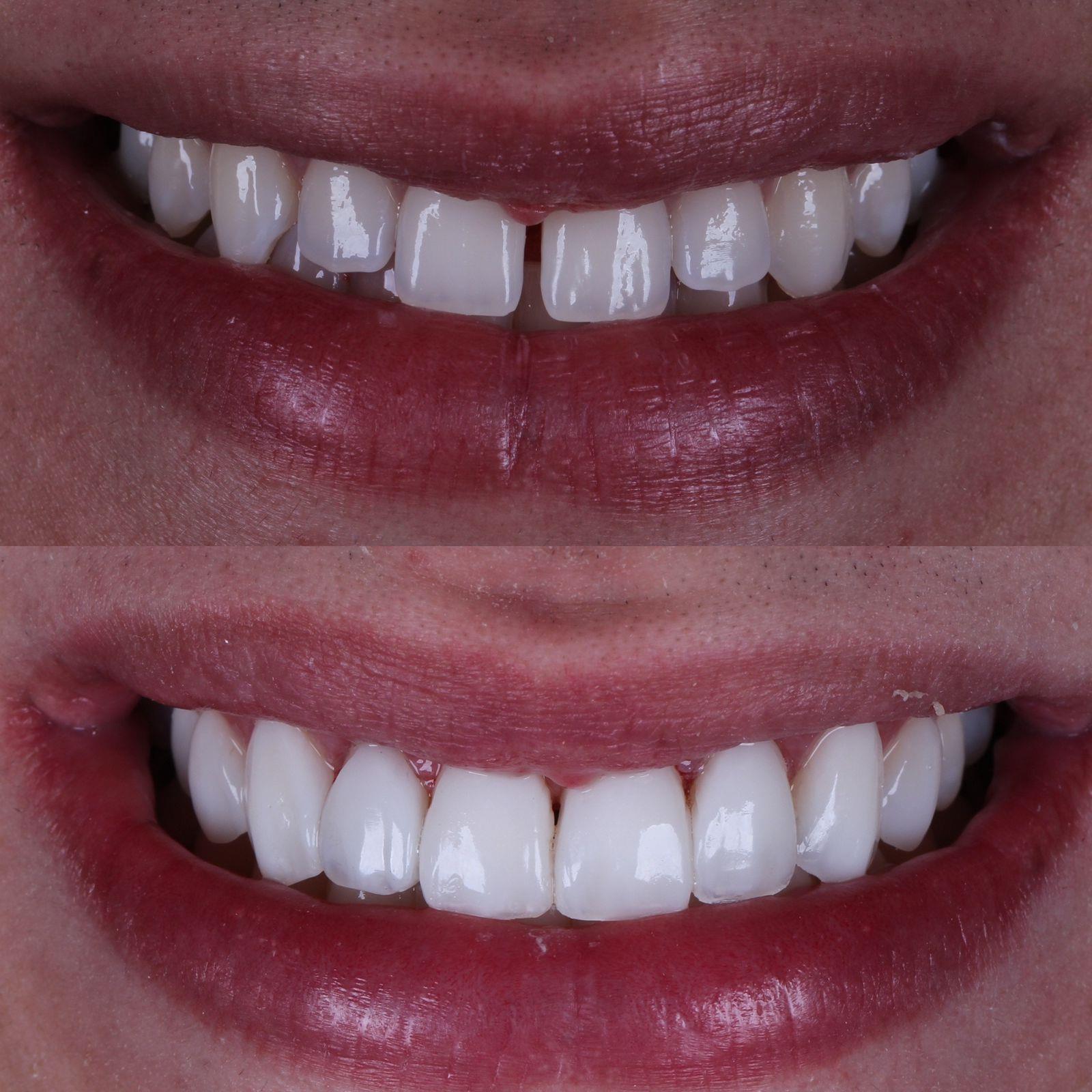 diastema_dentesseparados